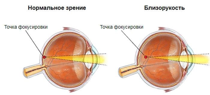 При каком зрении не берут в армию